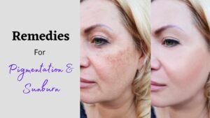 Remedies to Fight Hyperpigmentation and Sunburn