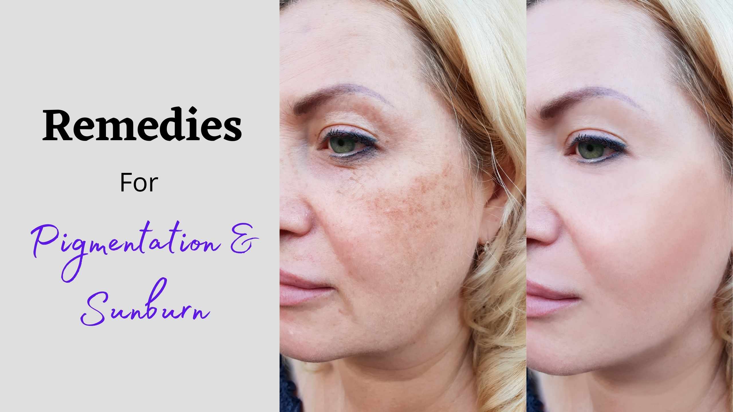 You are currently viewing Remedies to Fight Hyperpigmentation and Sunburn